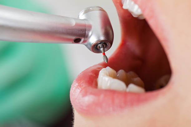 Best Emergency Tooth Extraction in Minco, OK